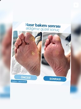 Nasır bakımı öncesi ve sonrası