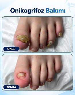Onikogrifoz bakımı öncesi ve sonrası